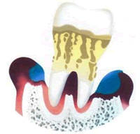 進行した歯周病イメージ