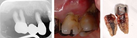 抜歯の対象となる歯 イメージ